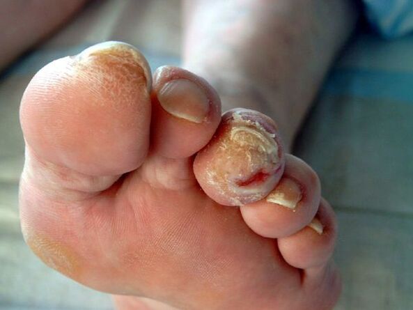 răzuire ciuperca unghiilor de la picioare